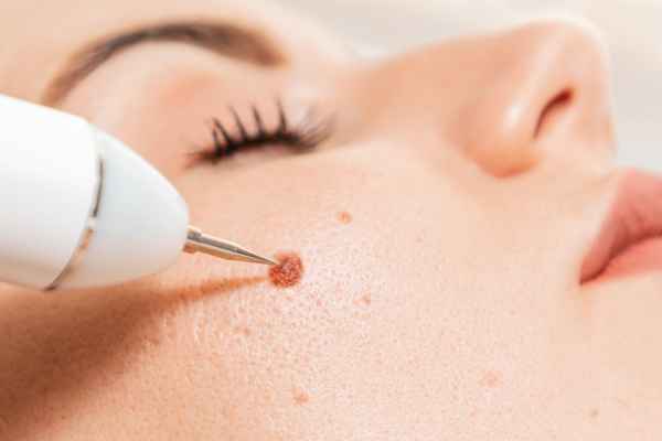 CryoPen: 5 Skin Concerns It May Be Used to Treat 3 What actually happens during a CryoPen treatment Dorchester?