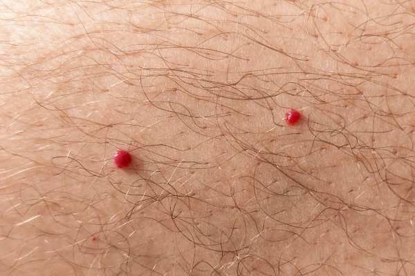CryoPen: 5 Skin Concerns It May Be Used to Treat 2 cherry angioma removal Dorchester