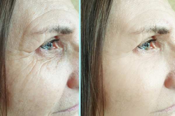 Why Do People Choose HIFU for a Non-Surgical Facelift? 4 How long can HIFU results last Dorchester?