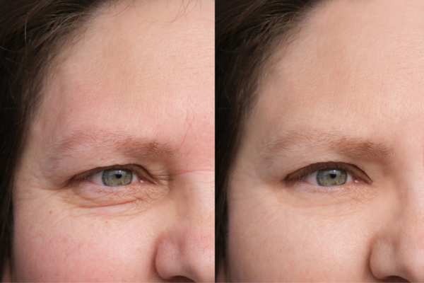 HIFU vs Botulinum Toxin: Understanding the Differences 4 How long do HIFU results last Dorchester?