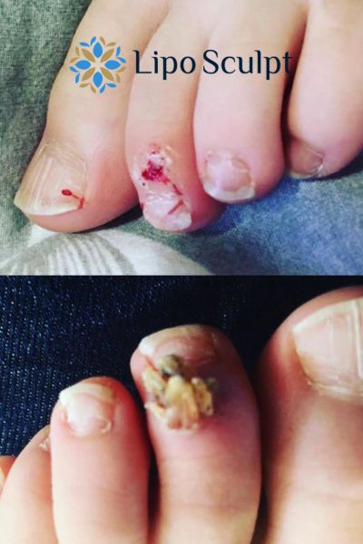 Wart removal customer results from Lipo Sculpt Dorchester
